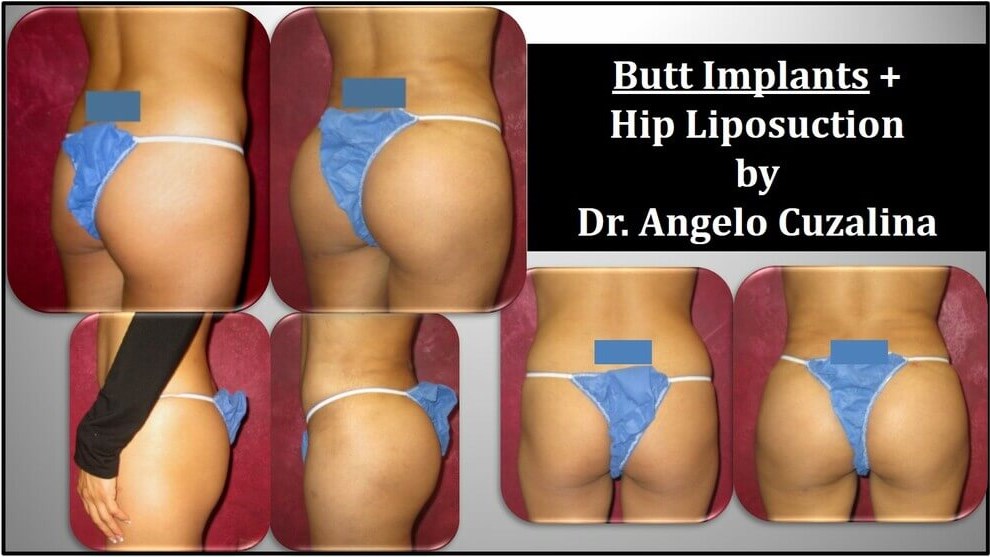 before and after butt implants